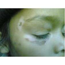 Kit For Vitiligo - Arogyam Pure Herbs