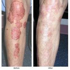 Kit For Psoriasis - Arogyam Pure Herbs